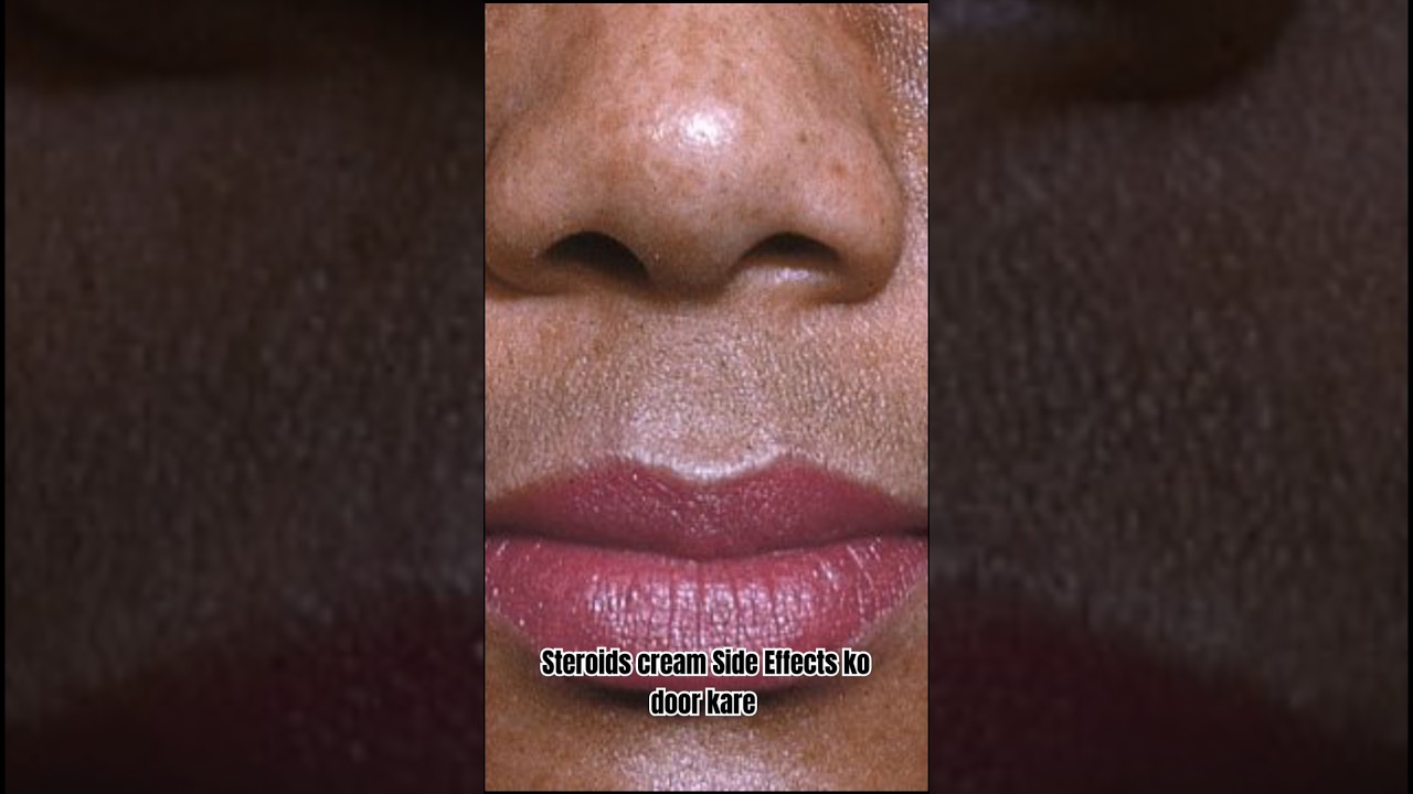 Steroid Cream Side Effects! स्टेरॉयड क्रीम के साइड इफेक्ट्स को कैसे दूर करें #shorts #ytshorts
