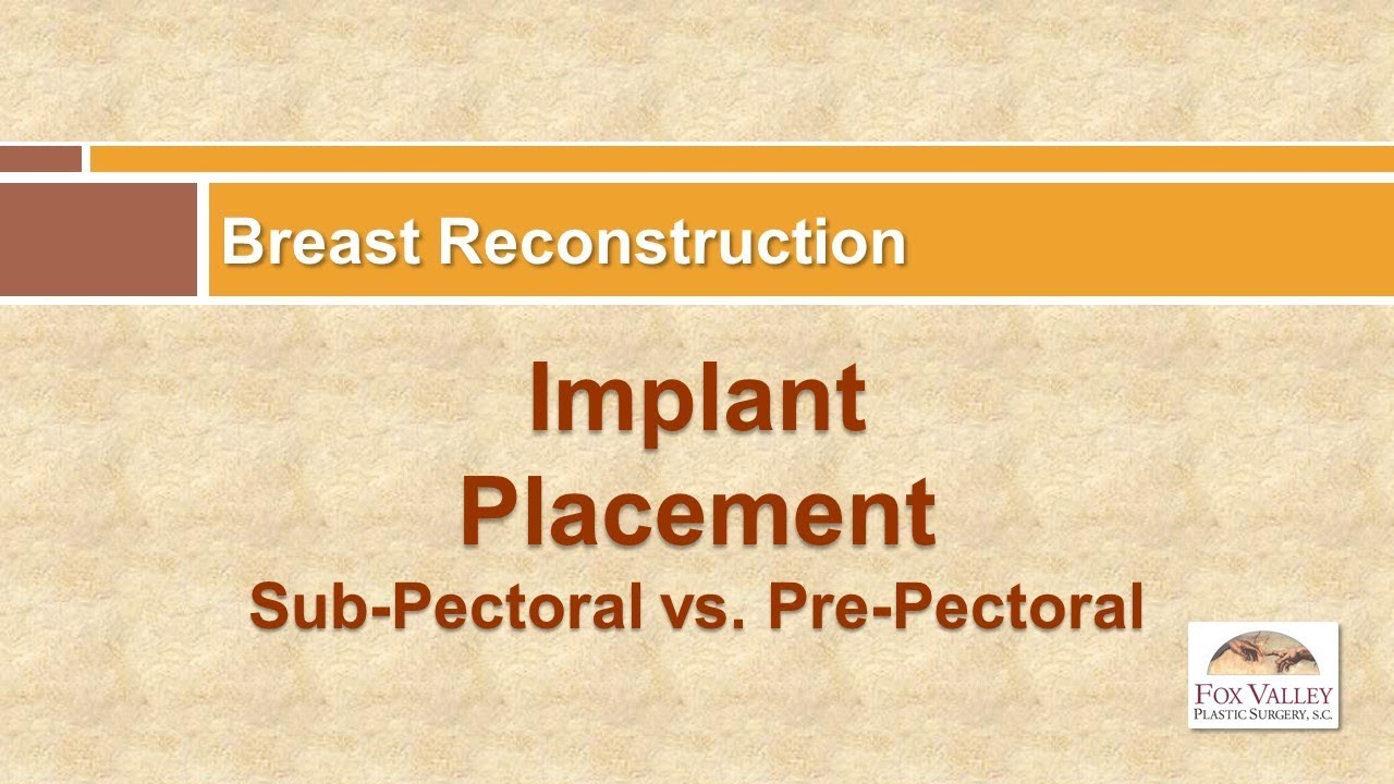 FVPS Breast Reconstruction Implant Placement: Sub-Pectoral vs. Pre-Pectoral
