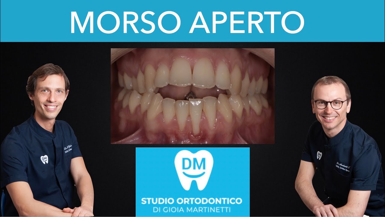 MORSO APERTO ANTERIORE - COME CORREGGERLO con ORTODONZIA con ALLINEATORI TRASPARENTI SENZA CHIRURGIA