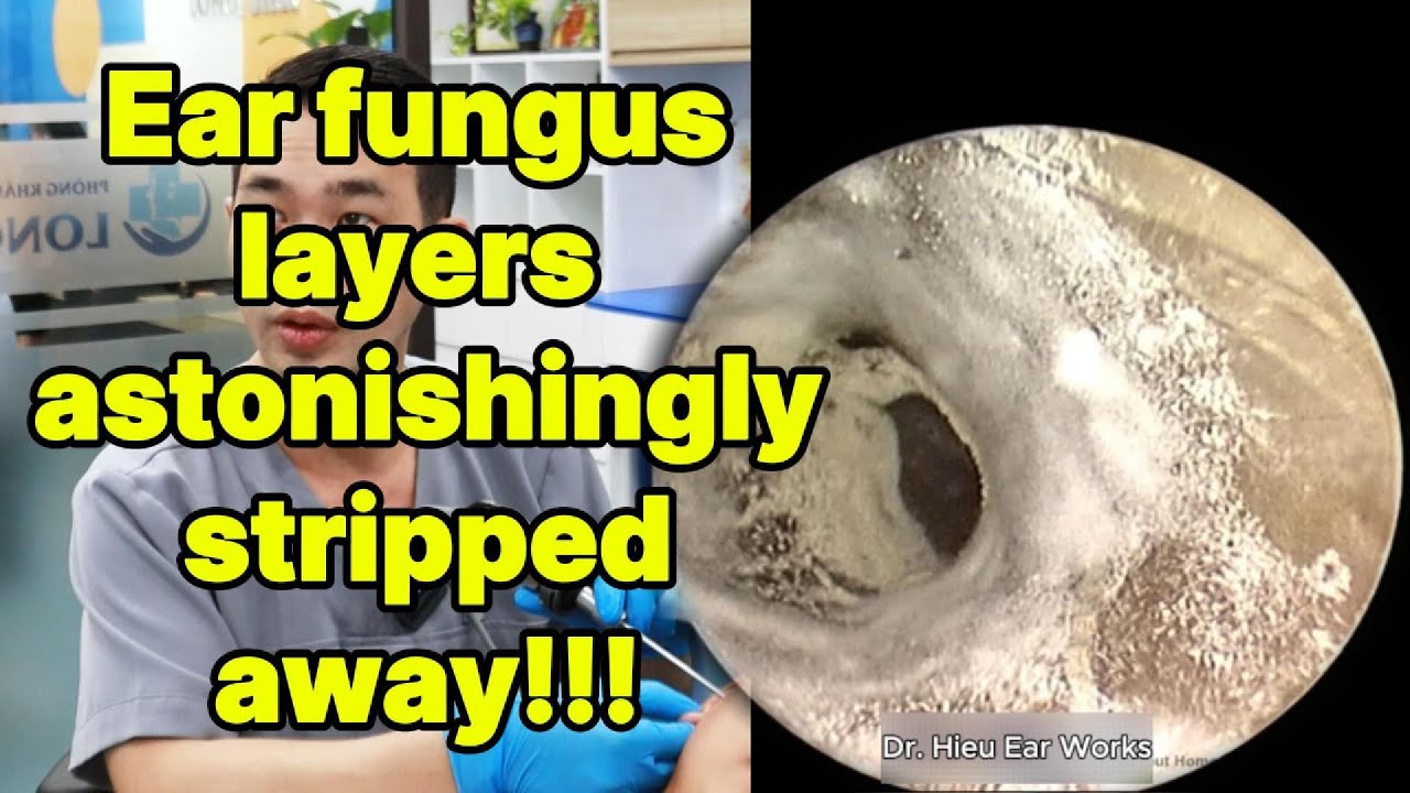 Ear fungus layers astonishingly stripped away | ear cleaning | ASMR earwax | soothing |relax|