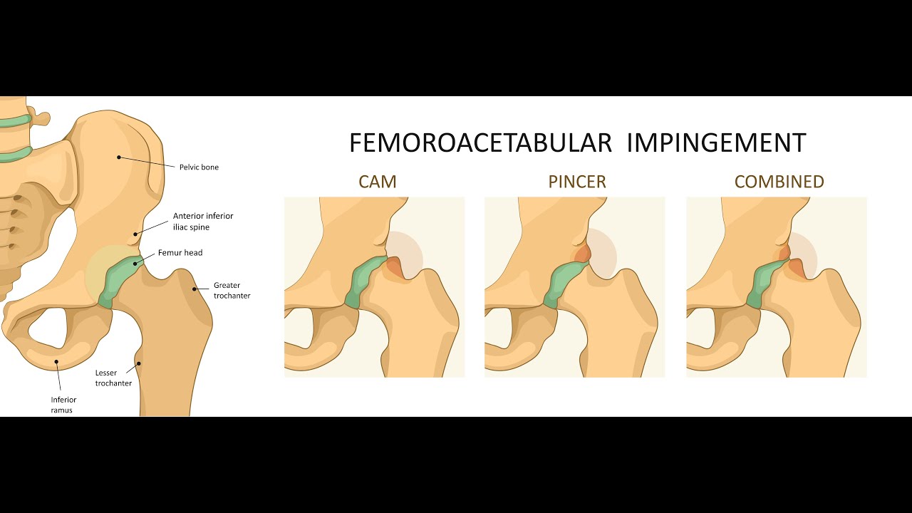 Hip Impingement and Labral Tears