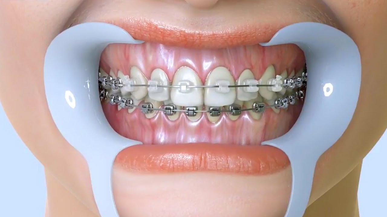 Niềng răng đã thay đổi hàm răng như thế nào?