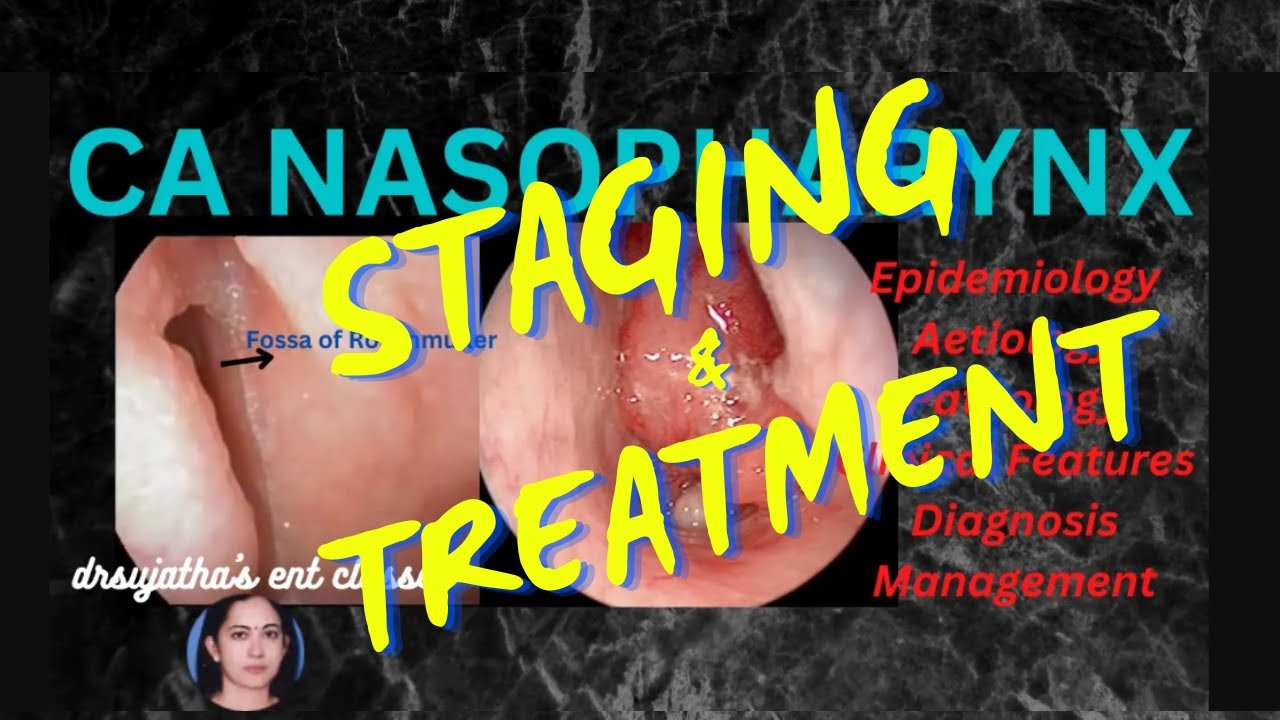 201.Nasopharyngeal Carcinoma Part 3/3  Staging and Treatment #clinicalexamination