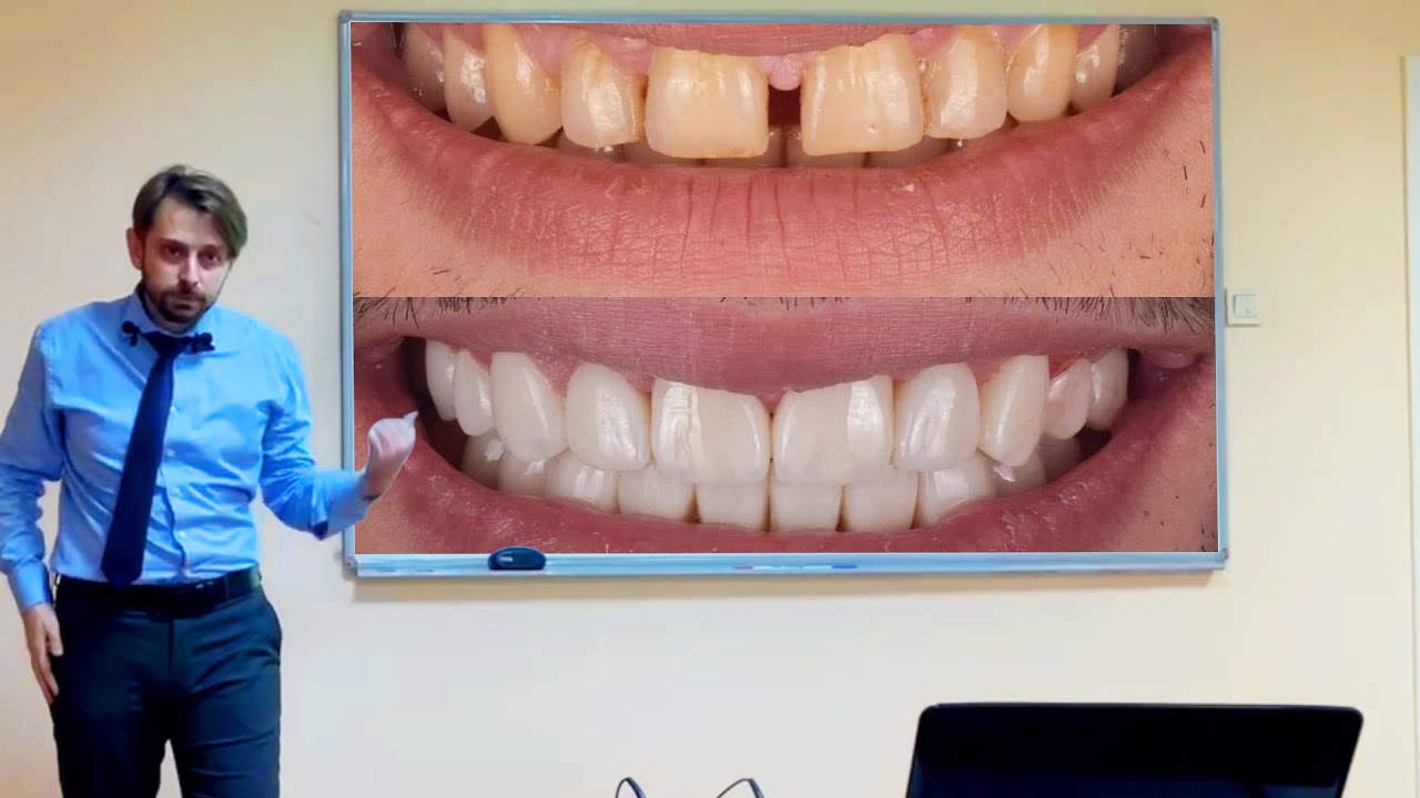 محاضرة عن الفينير (ابتسامة المشاهير)veneer(holleywood smile)