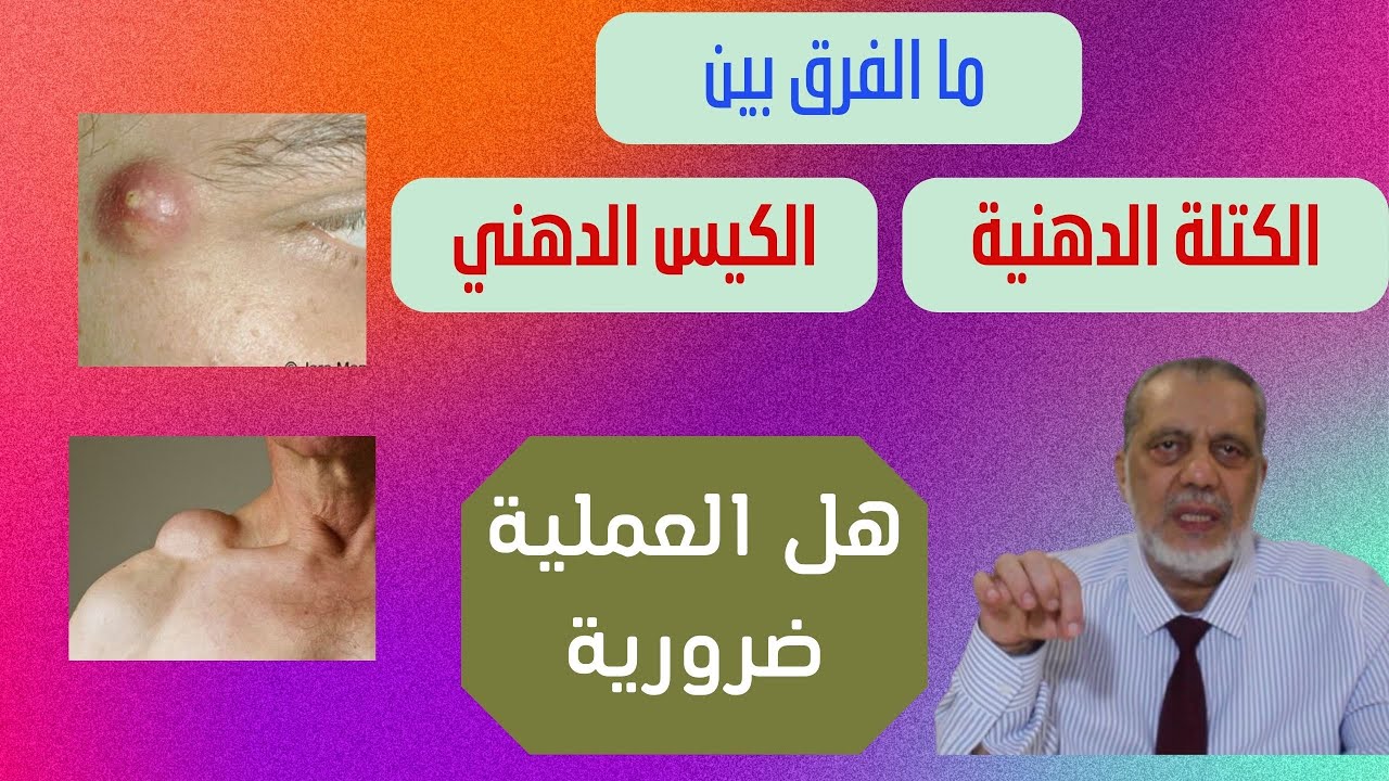 ما الفرق بين الكتلة الدهنية والكيس الدهني؟ كيف التشخيص؟ هل العملية ضرورية