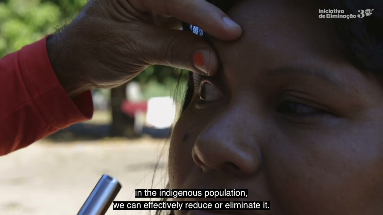 Brazil: actions to eliminate trachoma