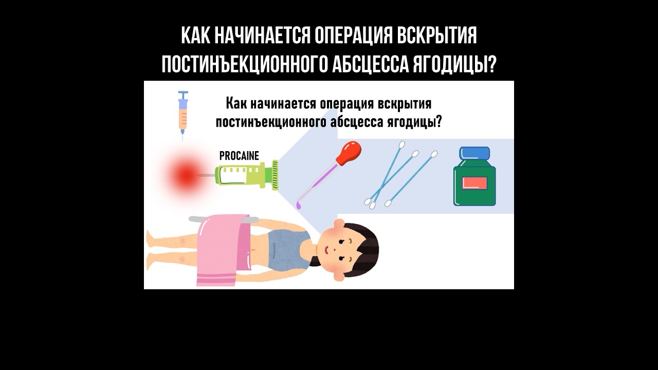 Как начинается операция вскрытия постинъекционного абсцесса ягодицы? #абсцесс #операция #хирургия