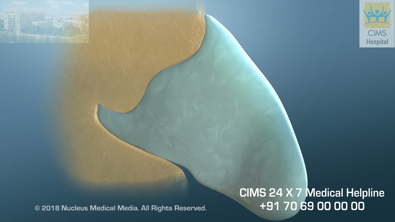 Nasal Septoplasty (Hindi) – CIMS Hospital