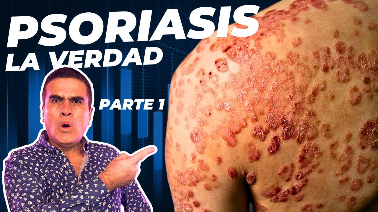 Qué es la Psoriasis 💔 Causas, Complicaciones y Zonas ❤️‍🩹 Dra Natalia Merino /  Dermatología