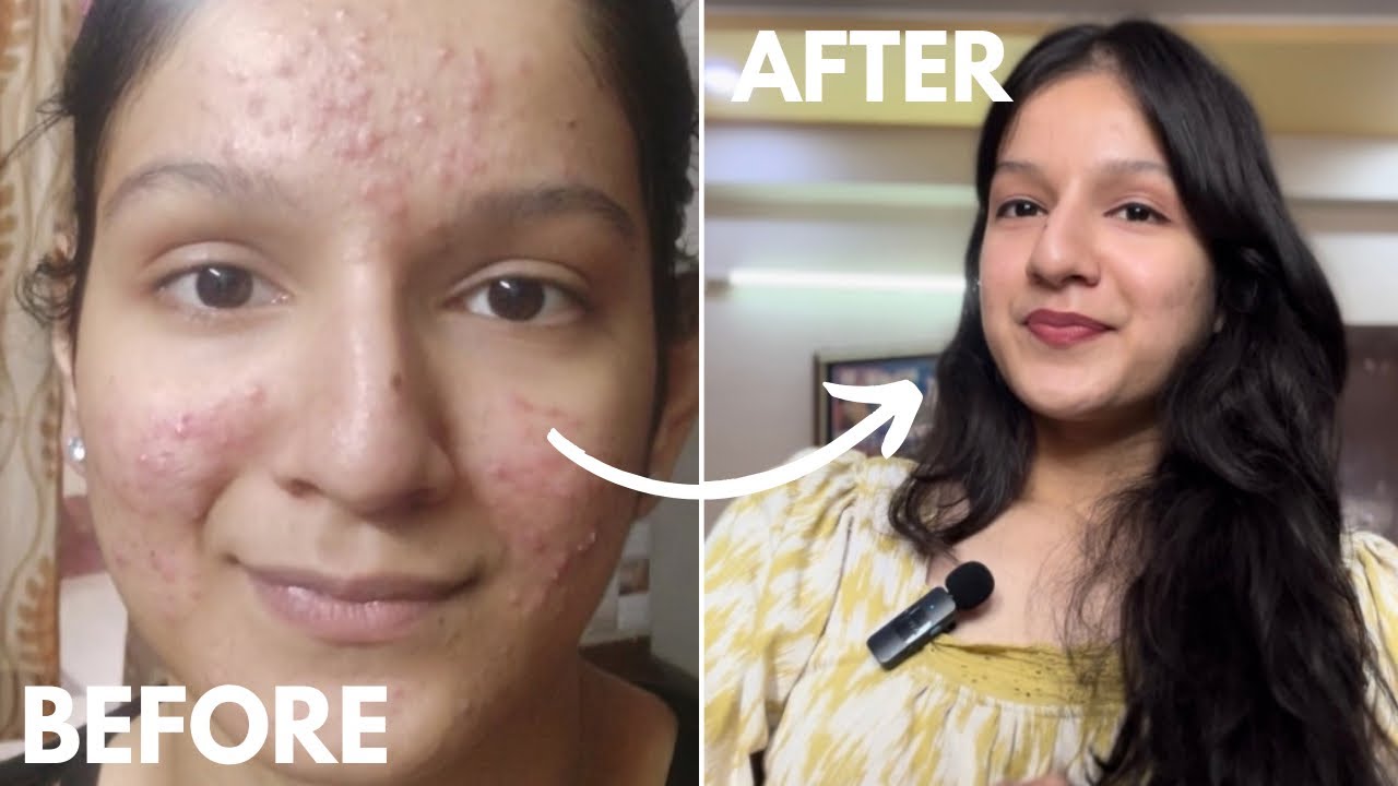 How i cleared my skin *Acne journey + Tips*