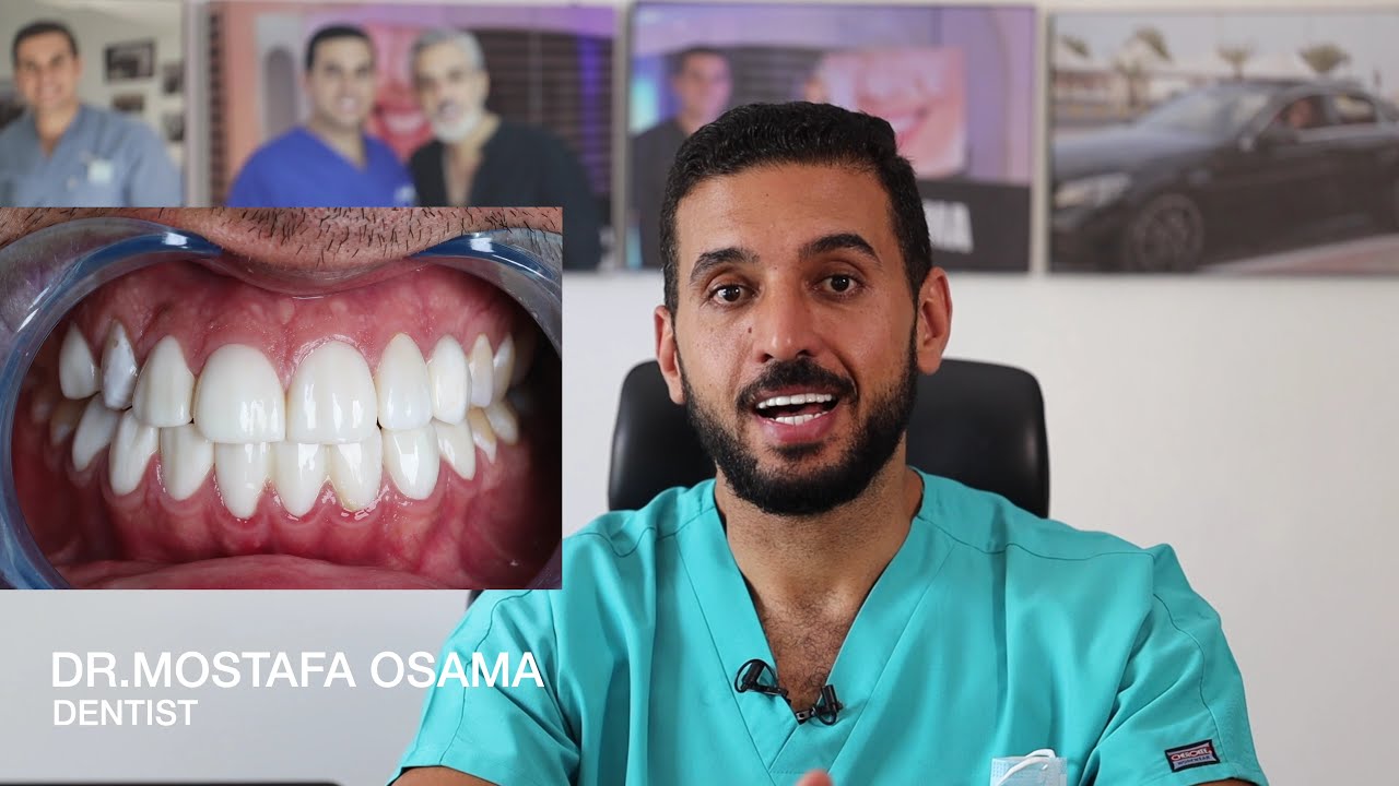 تجربه الڤينيرز ببرد وتخشين الاسنان