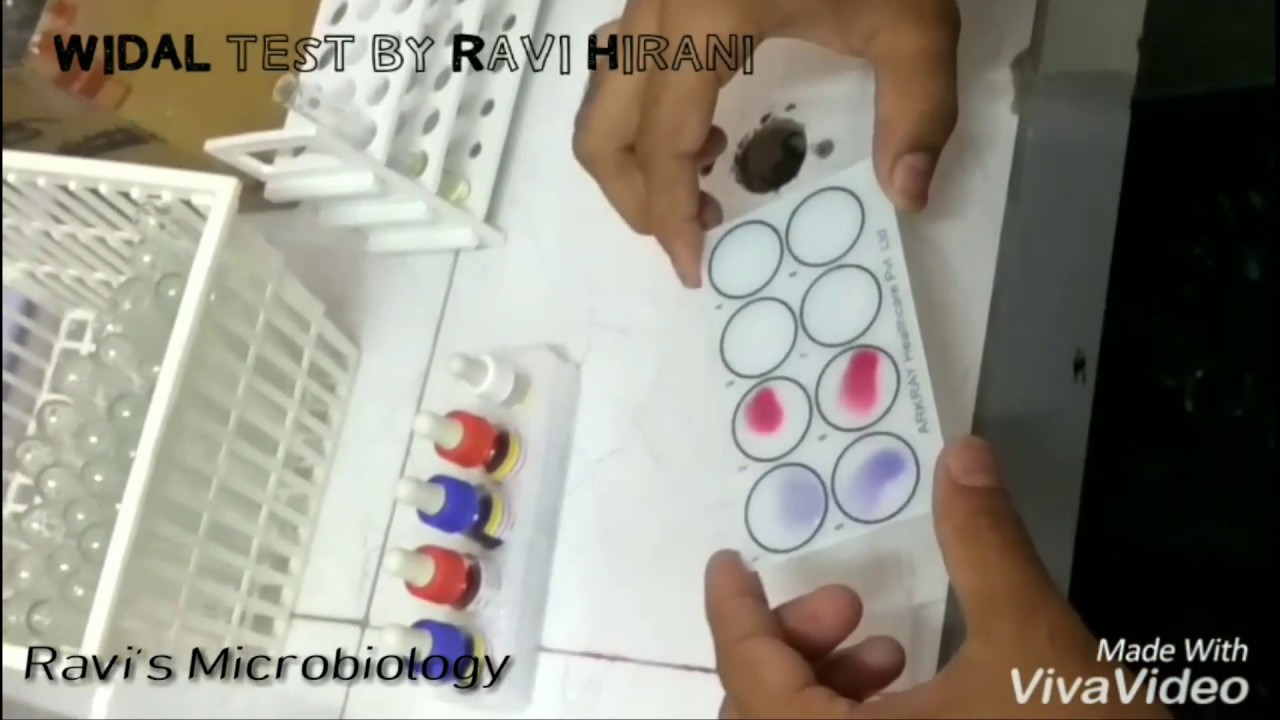 widal test in hindi