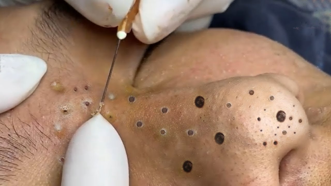 Remove Blackheads and Hidden Acne At Loan Nguyen Spa #158