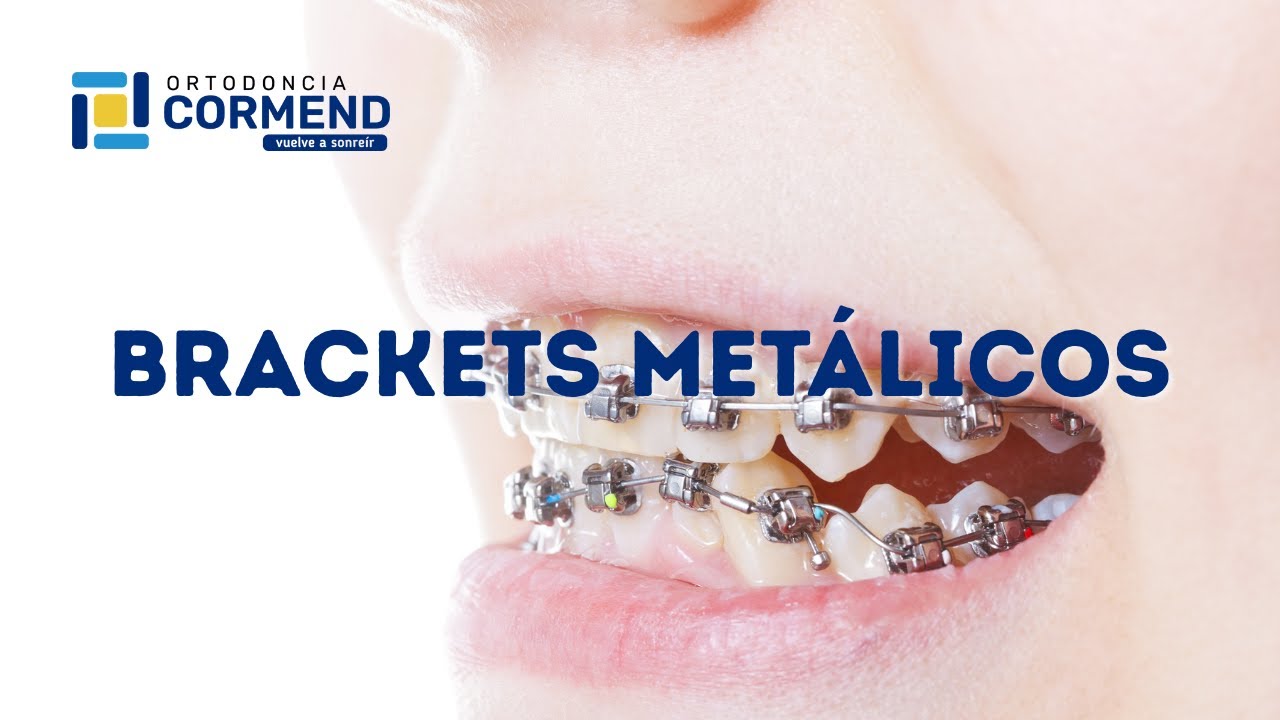 Brackets Metálicos Antofagasta - Clínica Dental Ortodoncia Cormend