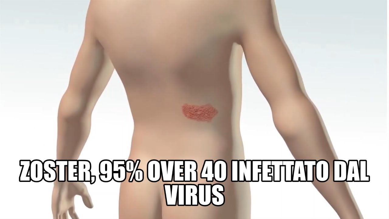Zoster, il 95% degli over 40 infettato dal virus