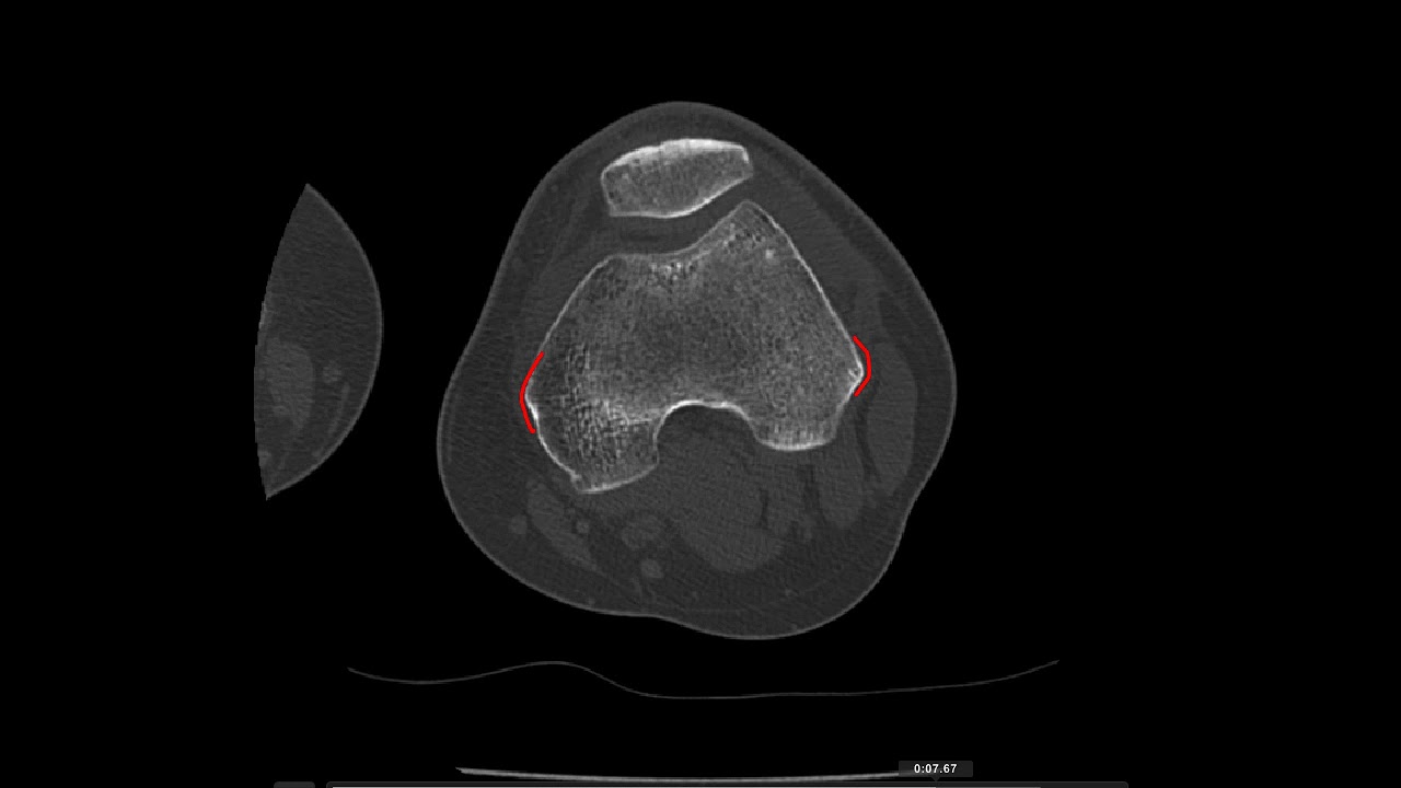 Anatomía CT Rodilla