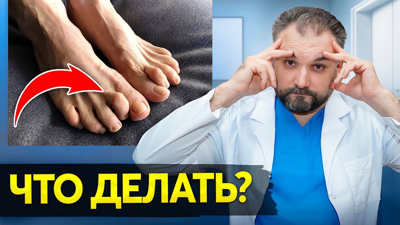 Молоткообразная Деформация Пальцев НОГ! Причины, Симптомы и Лечение