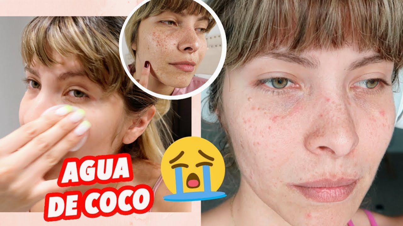 7 D&Iacute;AS USANDO AGUA DE COCO EN EL ROSTRO - TERMIN&Eacute; CON ACN&Eacute;? LA REALIDAD DE MI PIEL!!!