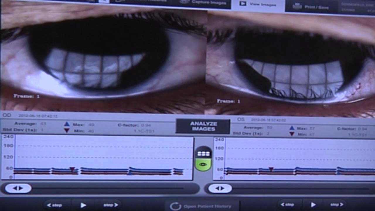 Eric Donnenfeld, MD discuss a Dry Eye Consultation for patients with TearScience technology
