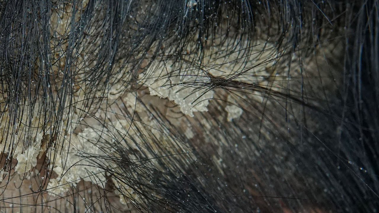 ASMR Satisfying Scalp Cleanse & Removal 