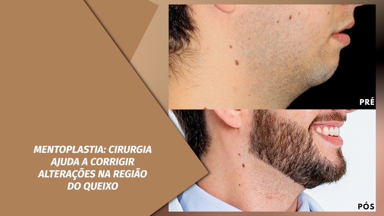 O SEU QUEIXO TE INCOMODA? CIRURGIA DE MENTOPLASTIA AJUDA A CORRIGIR.
