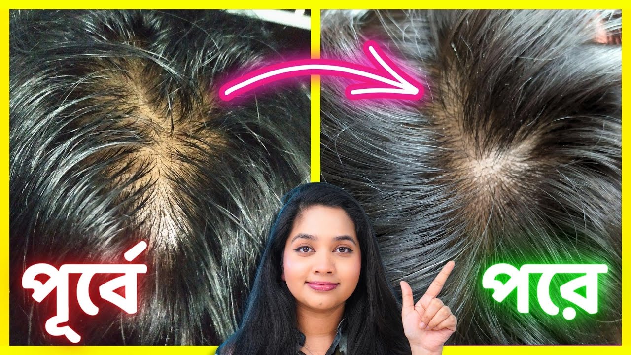 😲 চুল পড়া বন্ধ ও নতুন চুল গজানোর গ্যারান্টি!