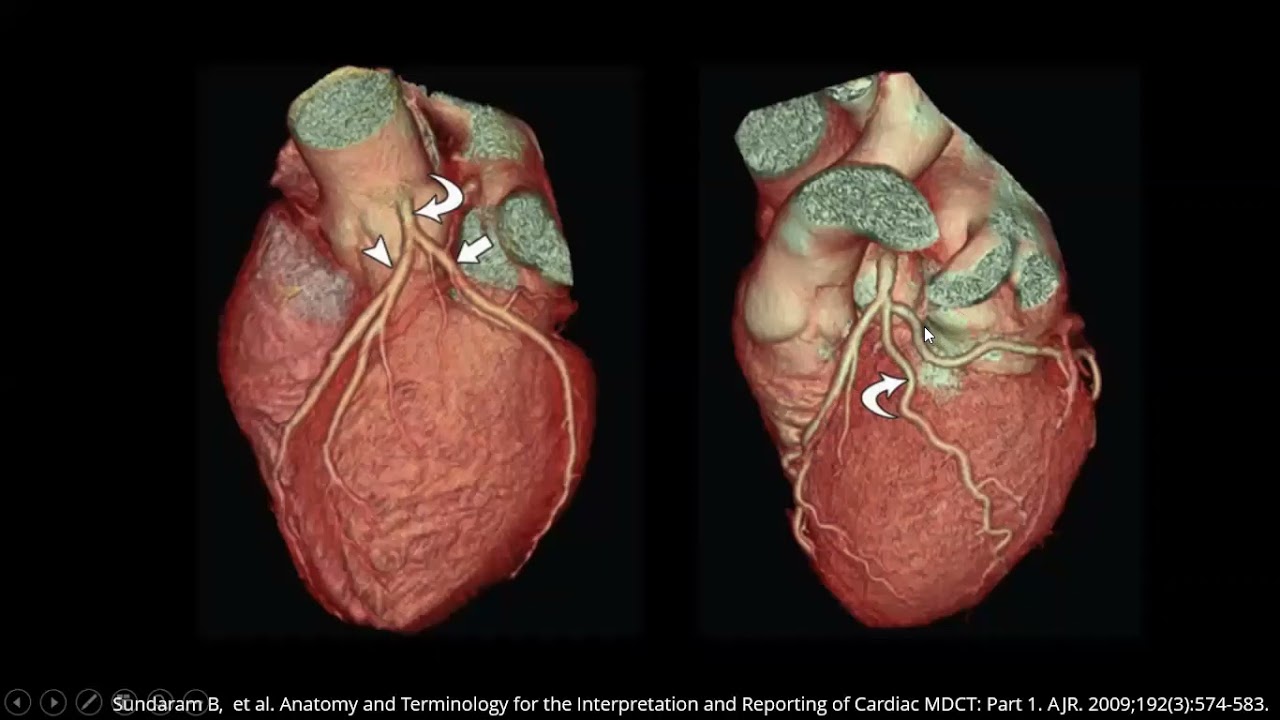 ANATOMIA Y VARIANTES NORMALES DE ARTERIAS CORONARIAS POR CT