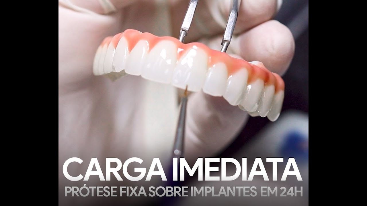 Carga Imediata - Prótese sobre implantes em até 24h