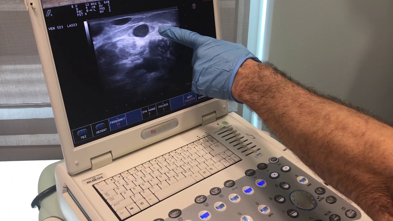 Vein Mapping Right Short Saphenous Vein