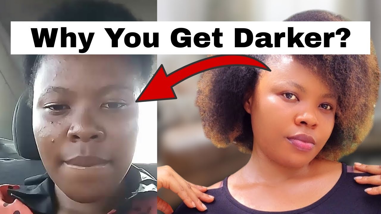 6 UNPOPULAR Reasons Why Your Skin Is DARKER / Why You have Hyperpigmentation 