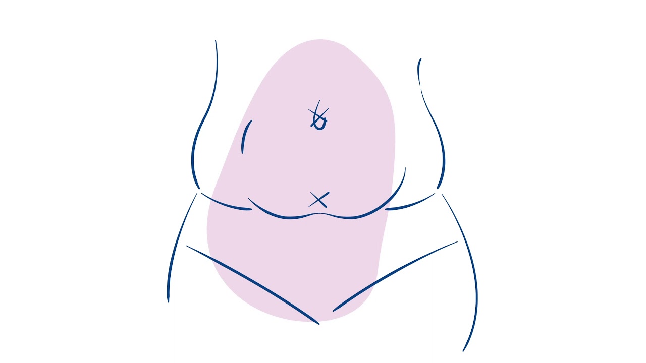 Acessa Procedure Overview Animation