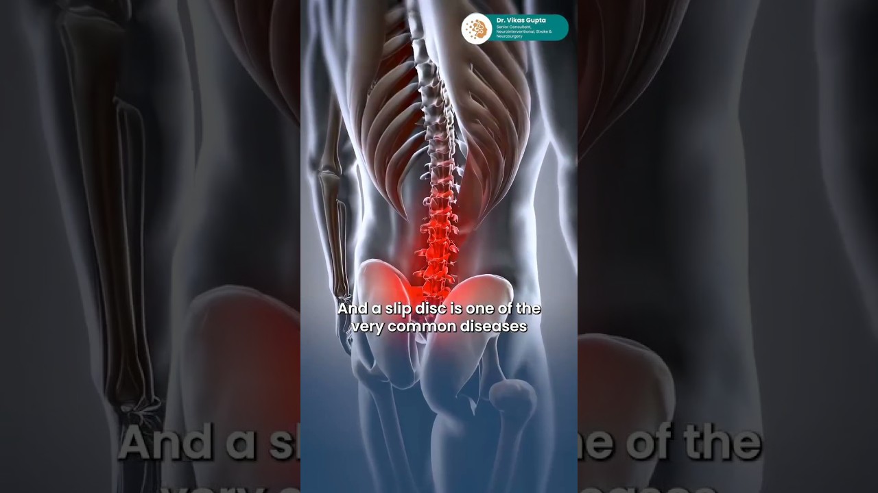 Can a Slip Disc Cause Neck Pain? | Disc Herniation & Nerve Compression Explained”