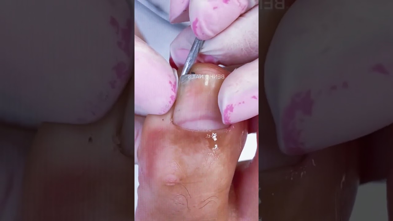 EP 09, Bad Toenail #toenails #feet #toes #prettytoes #nails #footcare #cutefeet #cutetoes #toerings