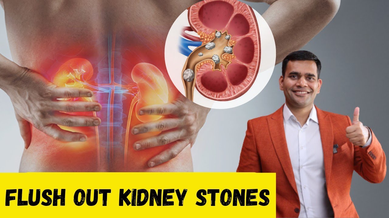 Dissolve  Kidney stones Naturally | Flush Out Kidney Stones - Dr. Vivek Joshi