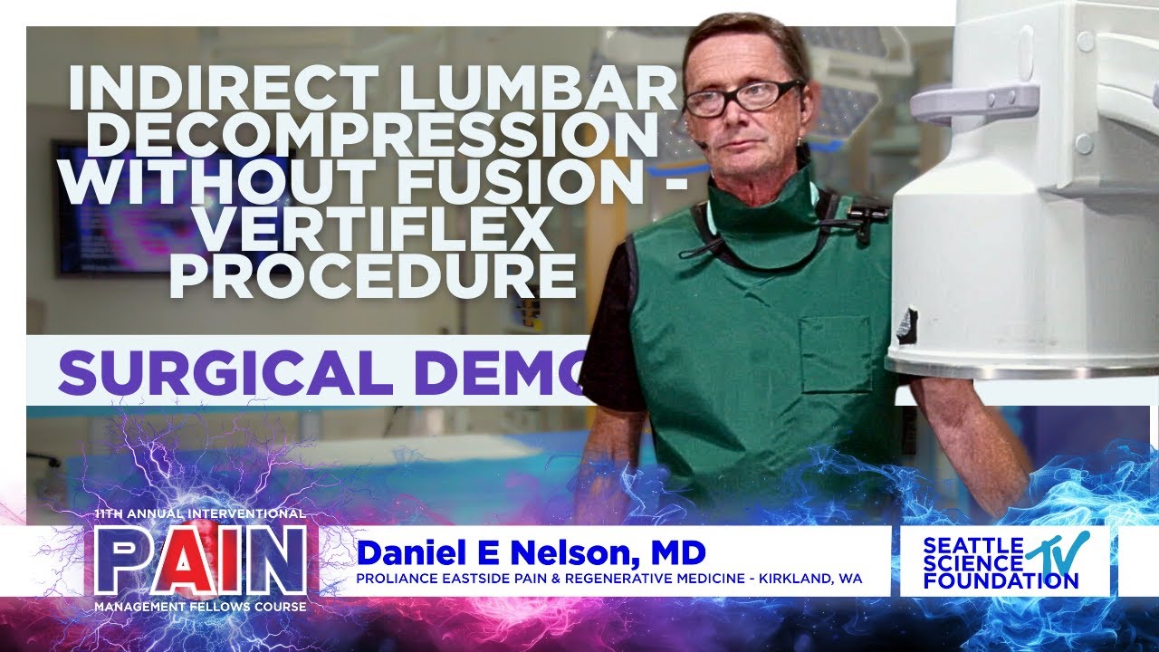 Indirect Lumbar Decompression without Fusion - Vertiflex Procedure - Daniel Nelson, M.D.