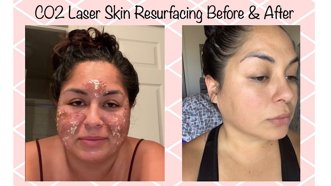 C02 Laser Resurfacing For Acne Scar Removal | My 7 Day Review