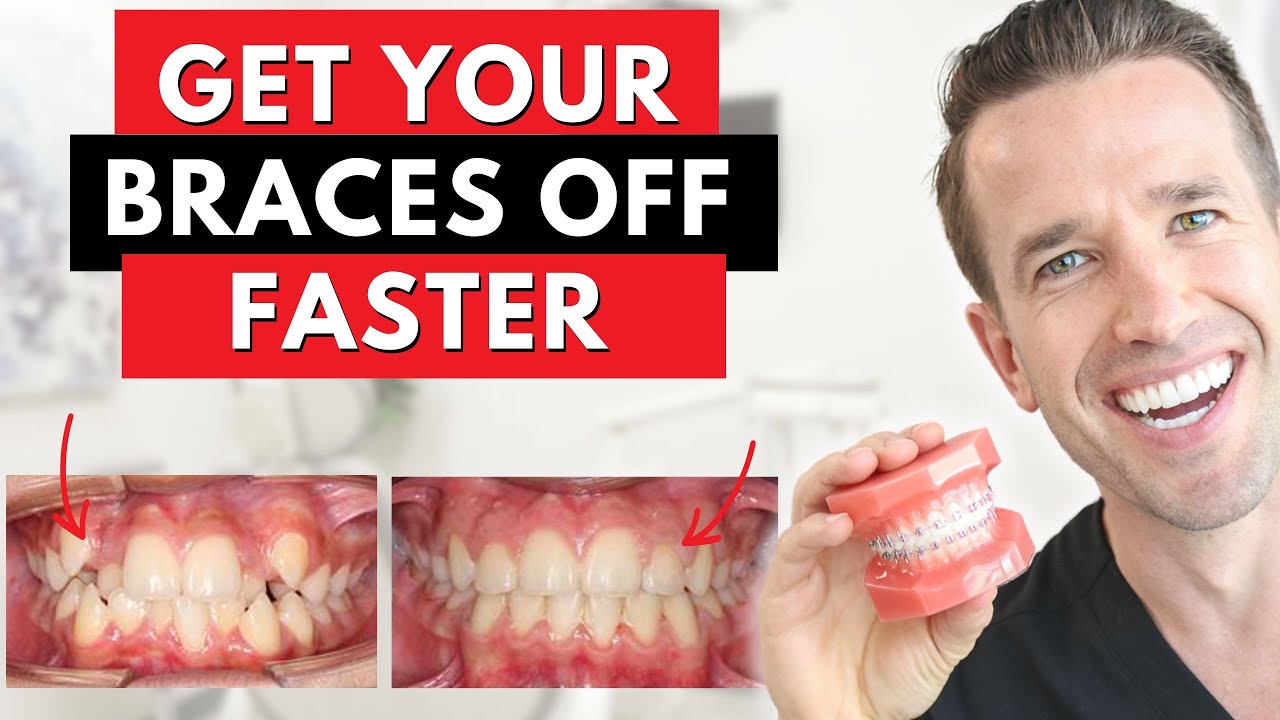 The Secret to Getting Your Braces Off Faster | Dr. Nate