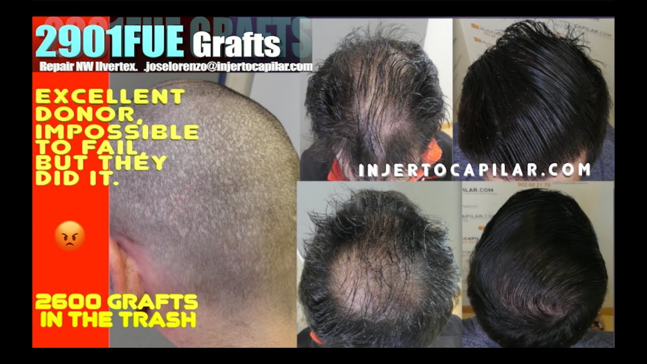 2901Grafts.Repair DPA NWII vertex. Crown. 10 mths update. 3,08 h/g.Injertocapilar.com.2956/2023