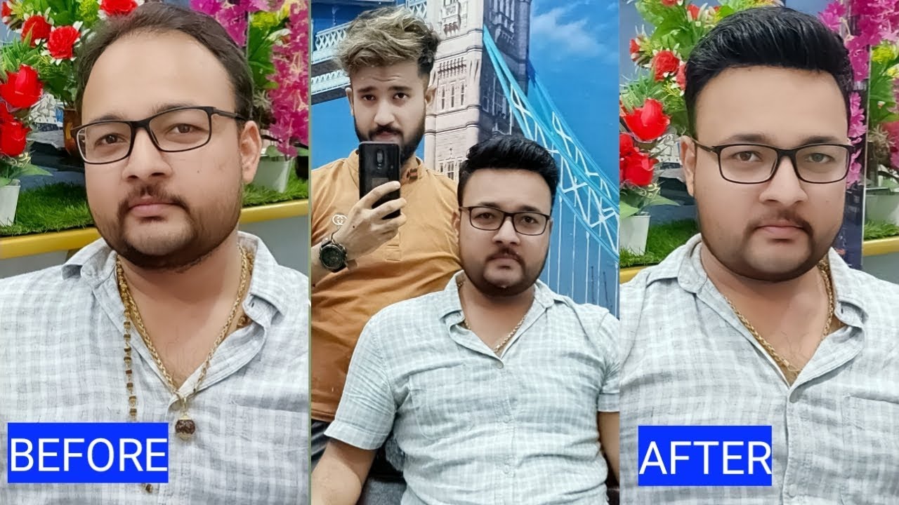 After & before non surgical hair transformation system by anas sheikh, call us 9650914665