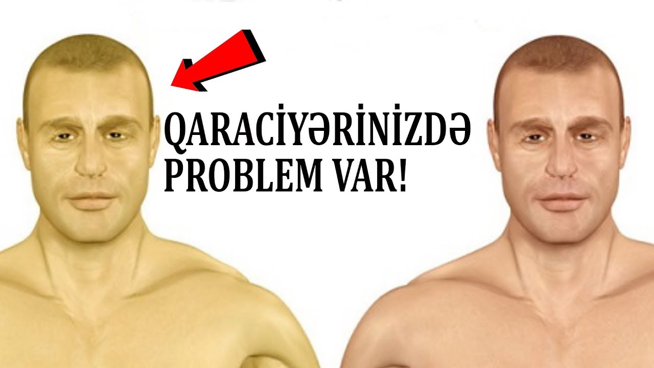 Dəriniz SARALIBSA, Qaraciyərinizdə bu xəstəlik var!