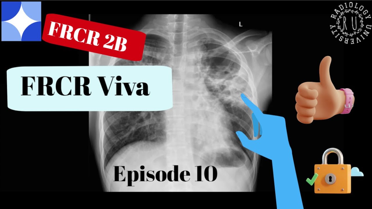 Episode 10: FRCR 2B viva experience part 5, Chest and Neuro Case