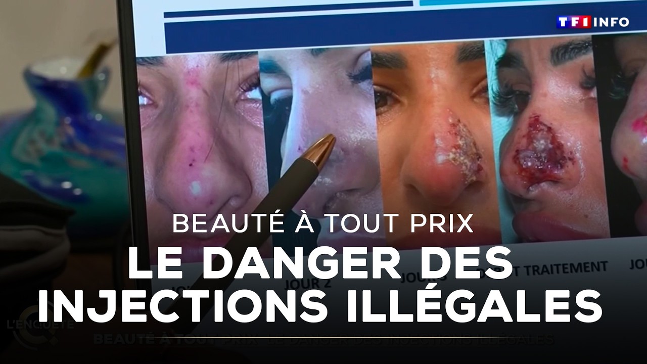 Beaut&eacute; &agrave; tout prix : le danger des injections ill&eacute;gales&nbsp;｜TF1 INFO
