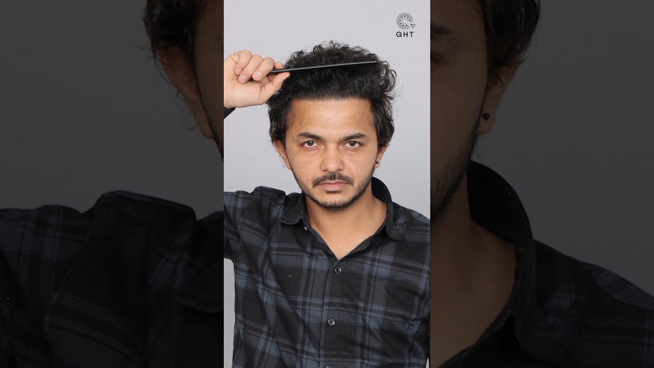 Hair Transplant Result | #qht #hairtransplant #trendingshort #shortsvideo&nbsp;#ytshortsvideo