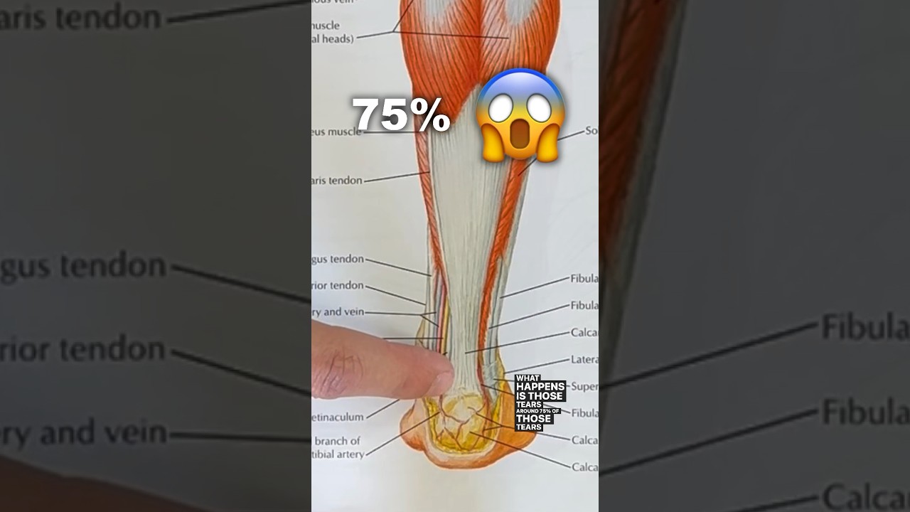 75% of all achilles tendon tears happen in this EXACT SPOT!