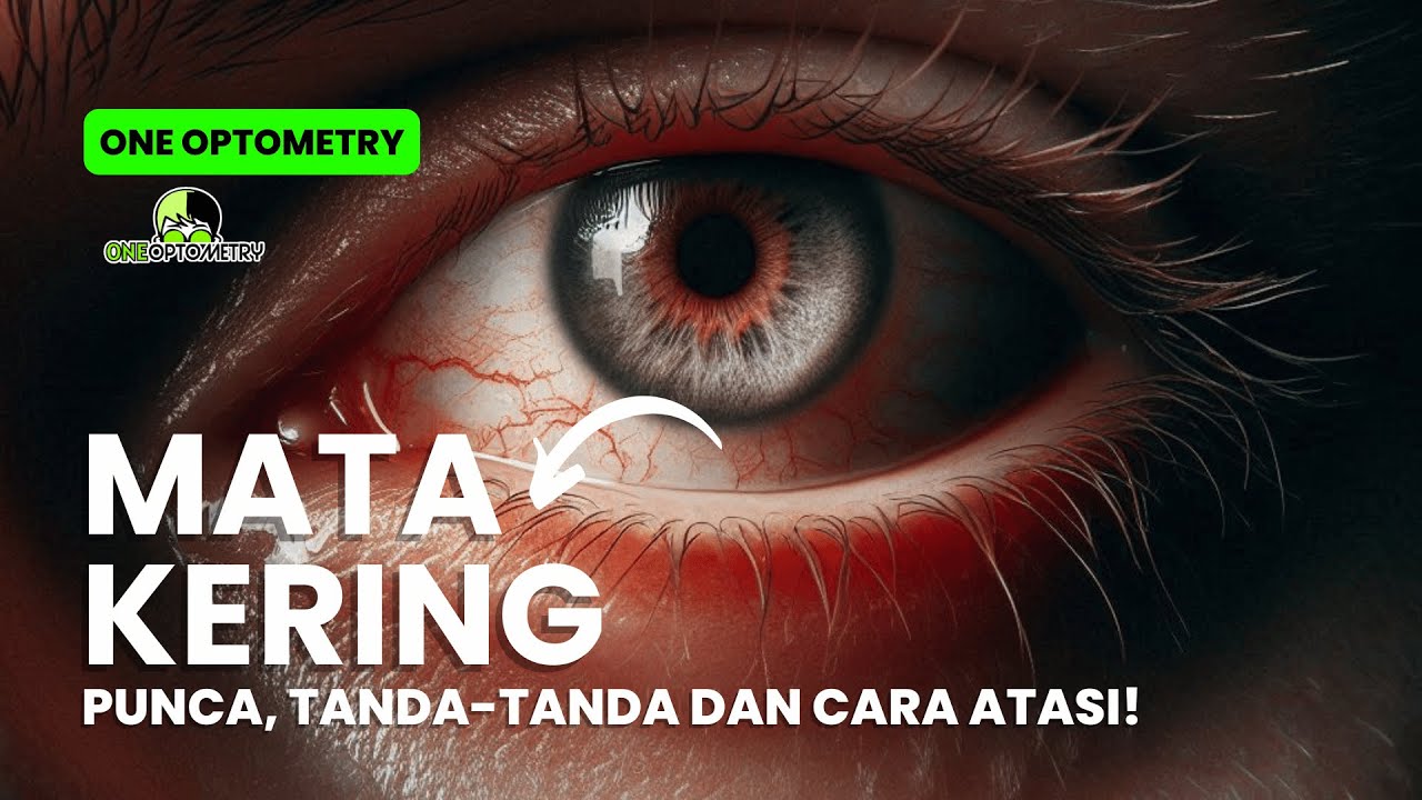 Cara Mudah Merawat Mata Kering: Tips dan Petua Untuk Penglihatan Lebih Selesa!