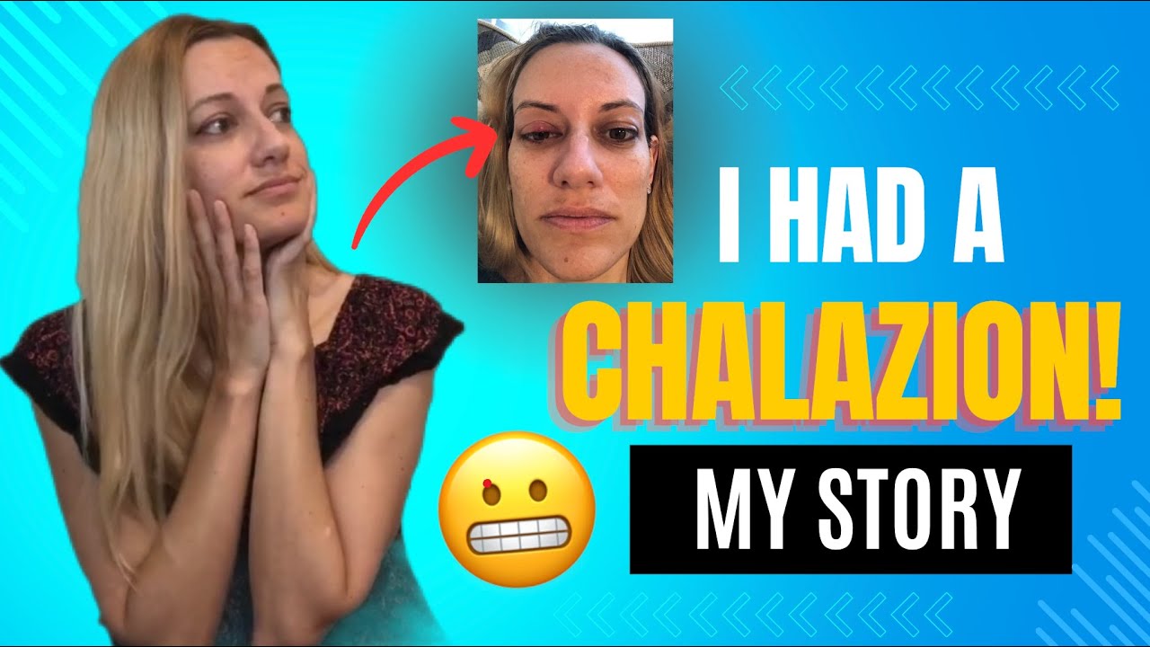 CHALAZION: Symptoms, Treatment, Risk Factors, Recovery. My Story...