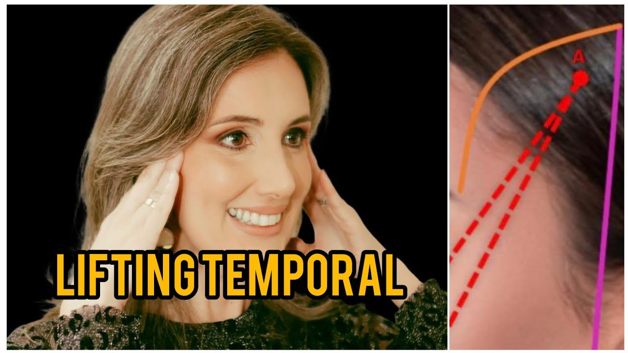 Lifting Temporal sem Fios! Saiba tudo sobre essa técnica