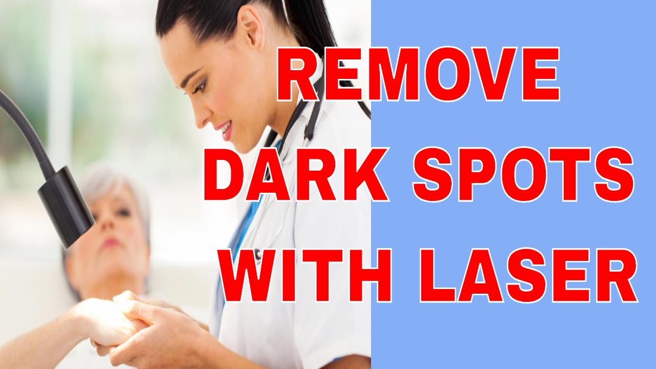 🙂🙂REMOVE DARK SPOTS WITH LASER