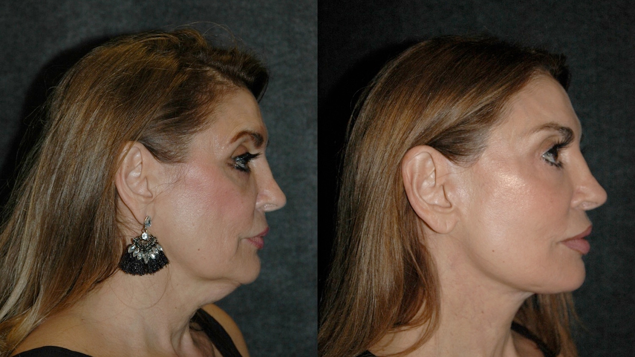 Deep Plane Facelift Before and After | Best Facelift Surgeon #deepplanefacelift