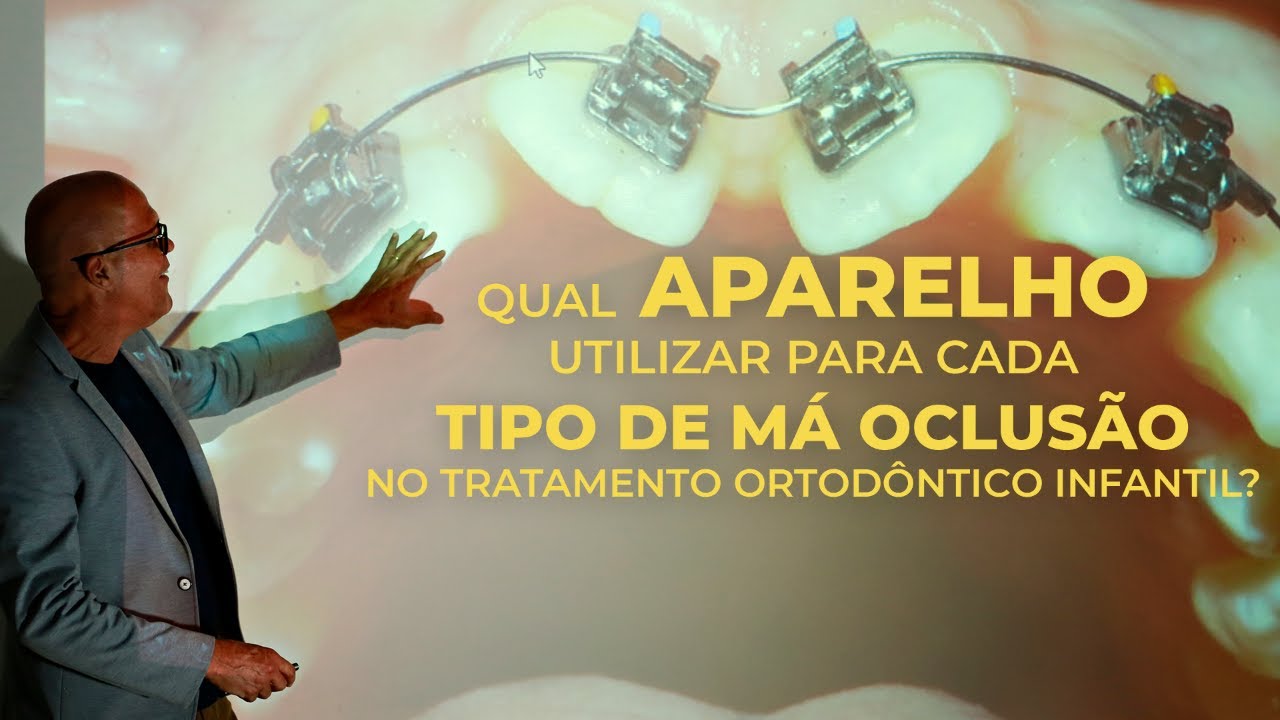 QUAL APARELHO UTILIZAR PARA CADA TIPO DE MÁ OCLUSÃO NO TRATAMENTO ORTODÔNTICO INFANTIL?